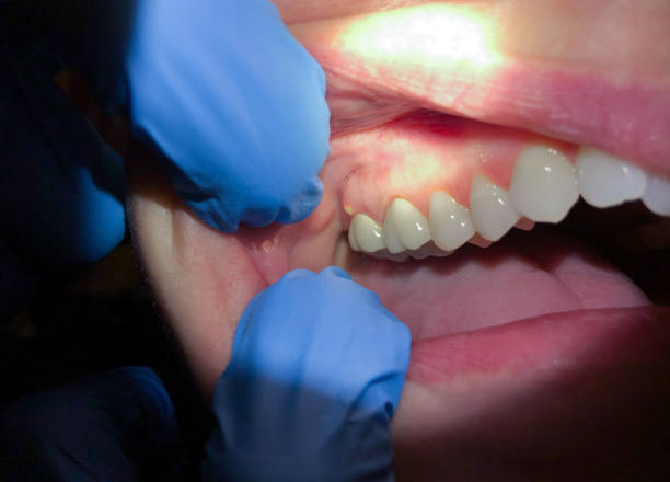 Best Emergency Wisdom Tooth Extraction in Caledonia, MS